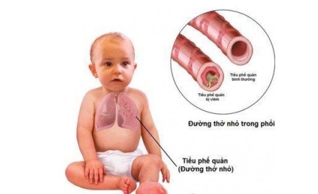 Viêm tiểu phế quản - Hình ảnh minh họa